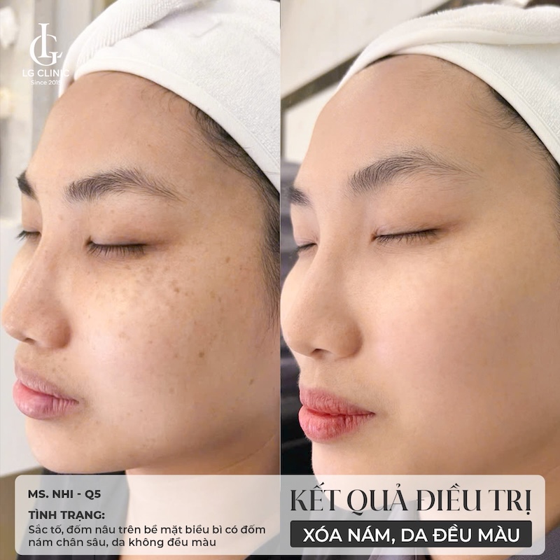 kết quả điều trị meso trị nám 3