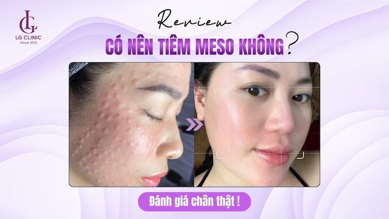 có nên tiêm meso hay không