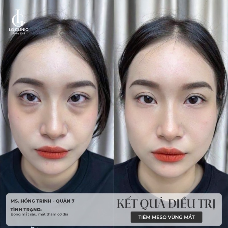 hình ảnh thực tế khi tiêm meso mắt trị thâm 2