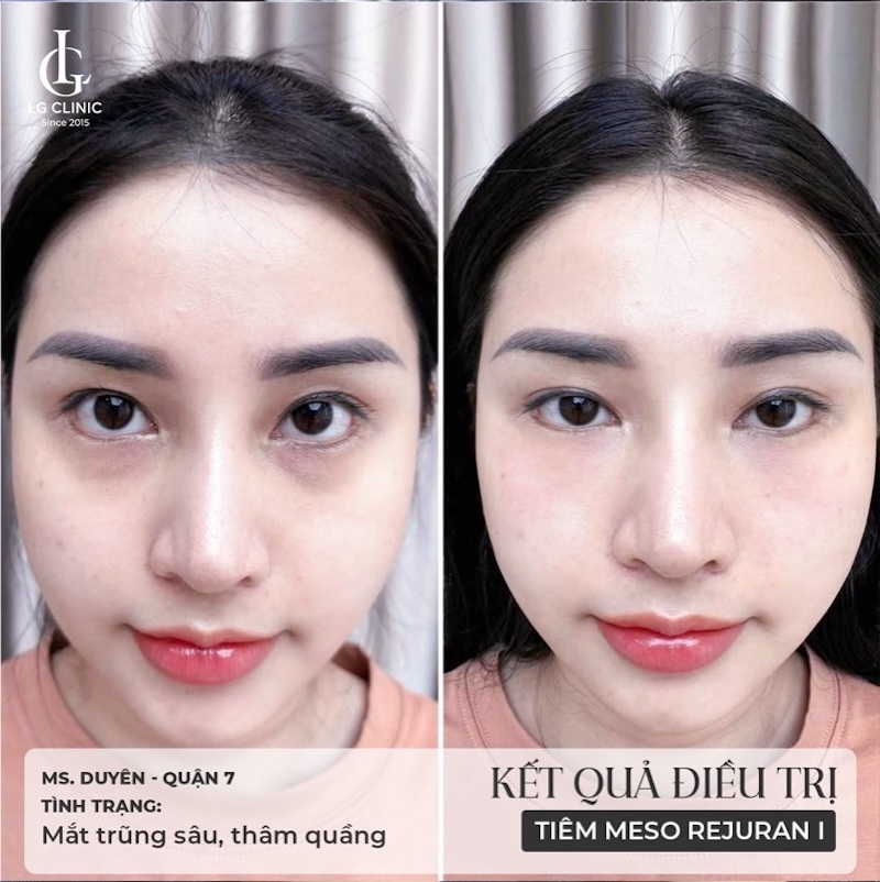 hình ảnh thực tế khi tiêm meso mắt trị thâm 1