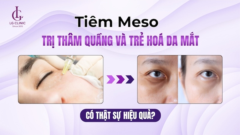 tiêm meso mắt trị thâm quầng