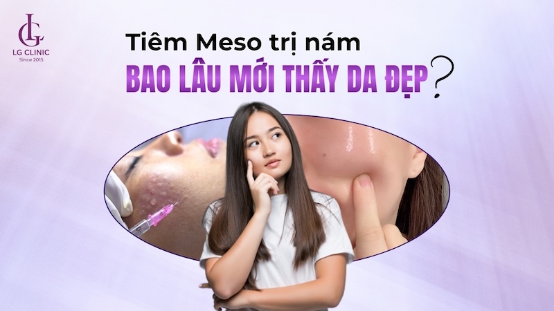 tiêm meso trị nám bao lâu có kết quả