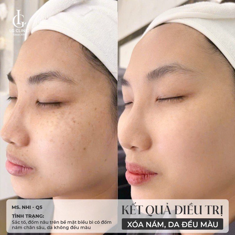 kết quả meso trị nám 1