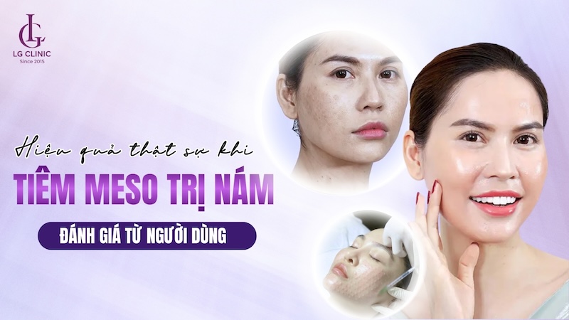 tiêm meso trị nám có hiệu quả không