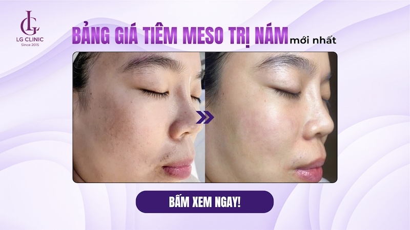 tiêm meso trị nám giá bao nhiêu