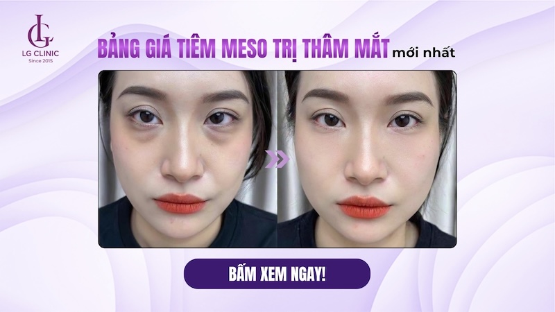 tiêm meso mắt giá bao nhiêu
