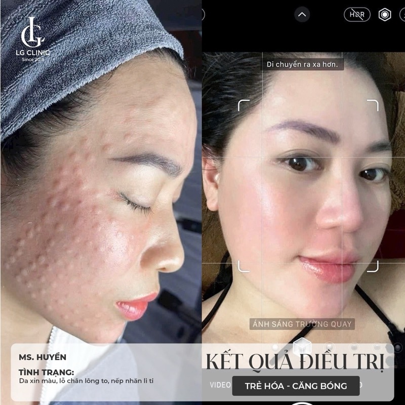 kết quả sau khi tiêm meso căng bóng da 1