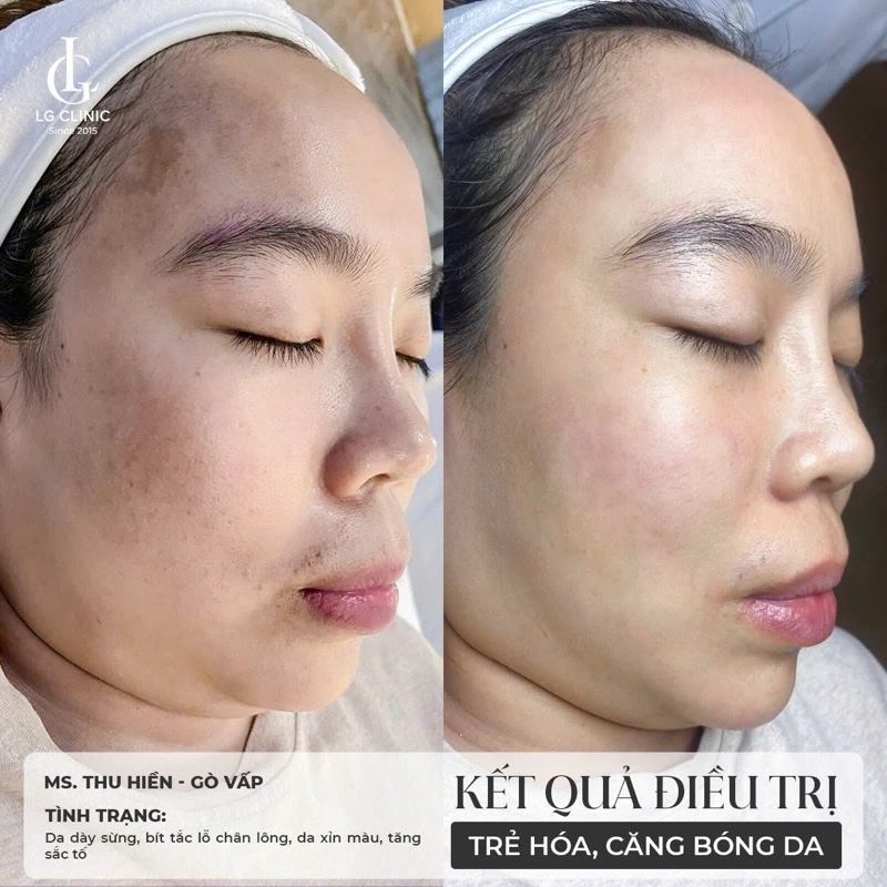 kết quả sau khi tiêm meso căng bóng da 2