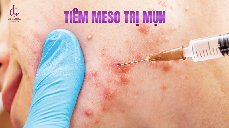 Mesotherapy