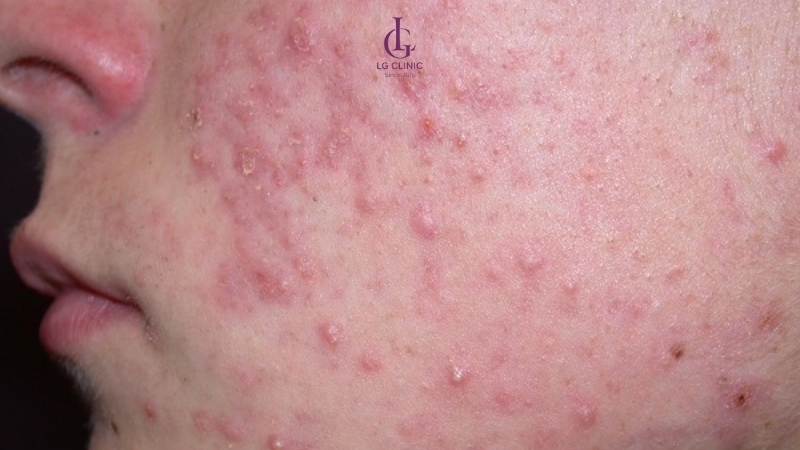 mụn viêm dày đặc không nên tiêm meso