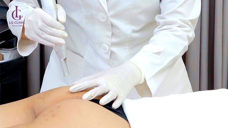 cách trị thâm mông sau sinh