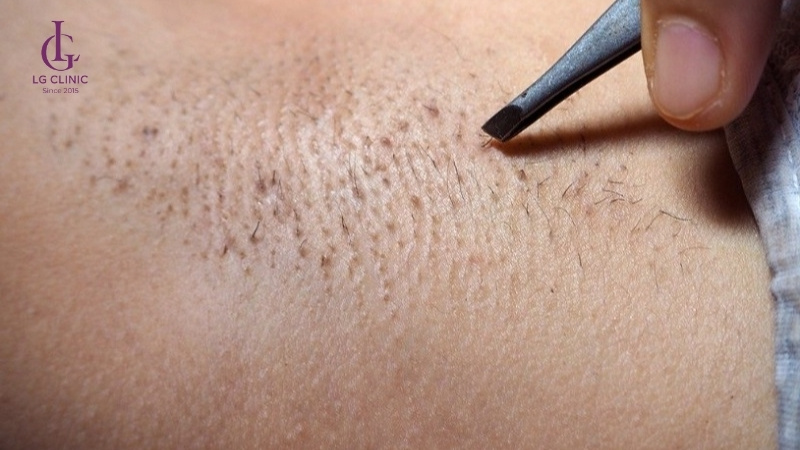 cách trị thâm nách bằng cà chua