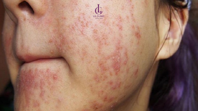 dấu hiệu nhận biết nhiễm corticoid