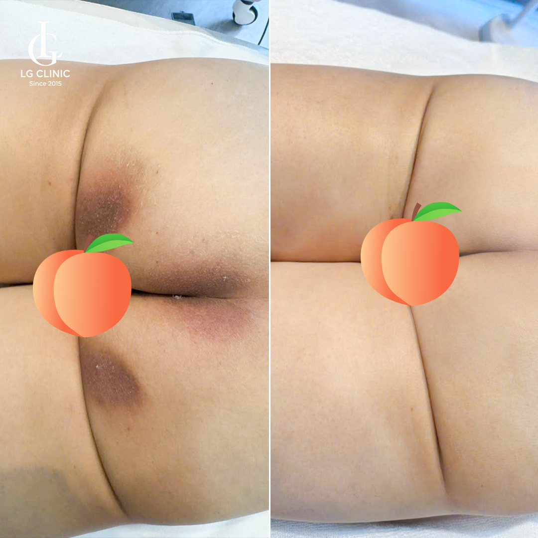 trị thâm mông bằng laser