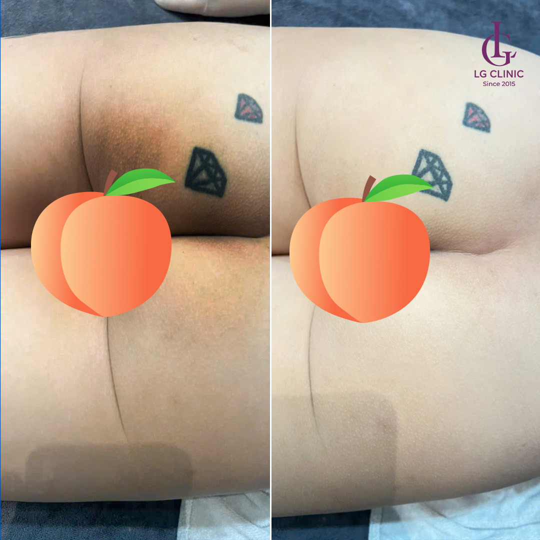 hình ảnh trị thâm mông - cách trị thâm mông bằng Vaseline