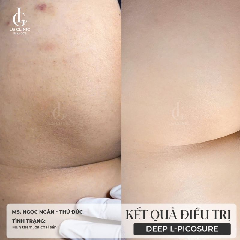 hình ảnh trị thâm mông bằng laser - hình ảnh mông thâm mụn