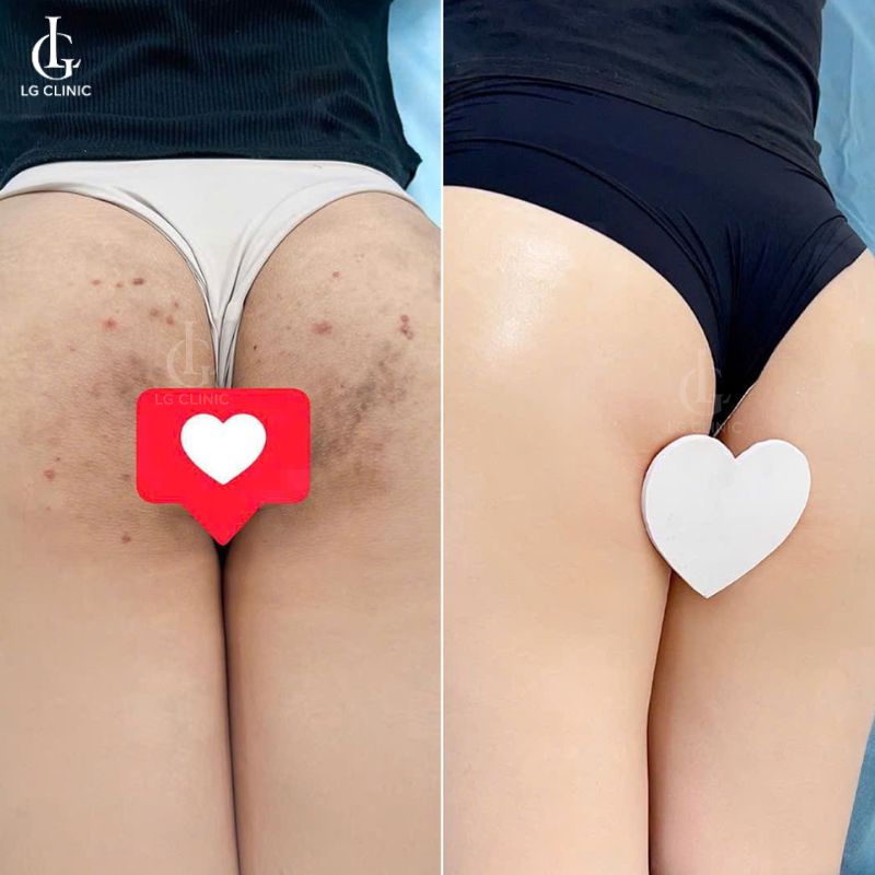 hình ảnh trị thâm mông bằng laser - hình mông thâm đen