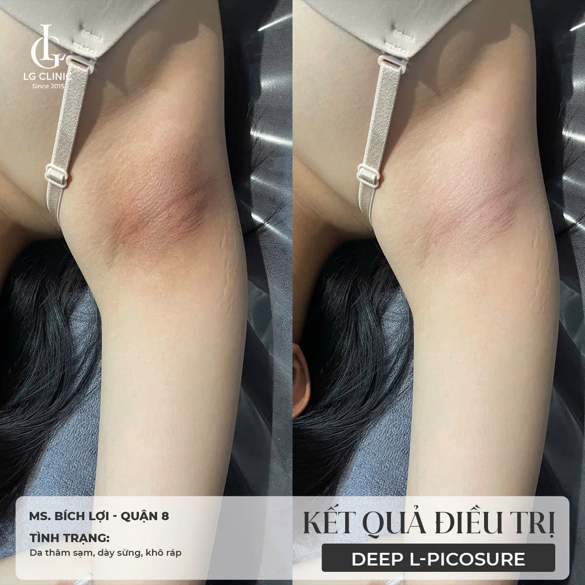 Hình ảnh trị thâm nách bằng laser