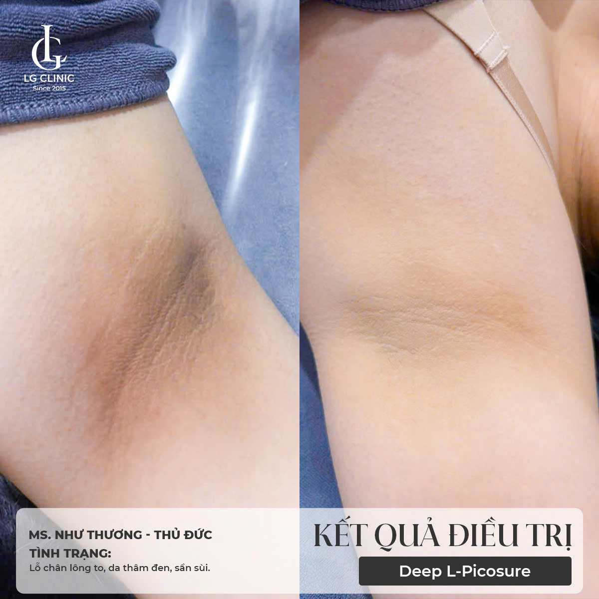 Hình ảnh trị thâm nách bằng laser