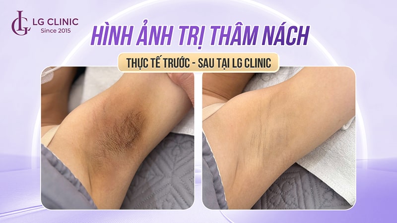 hình ảnh trị thâm nách