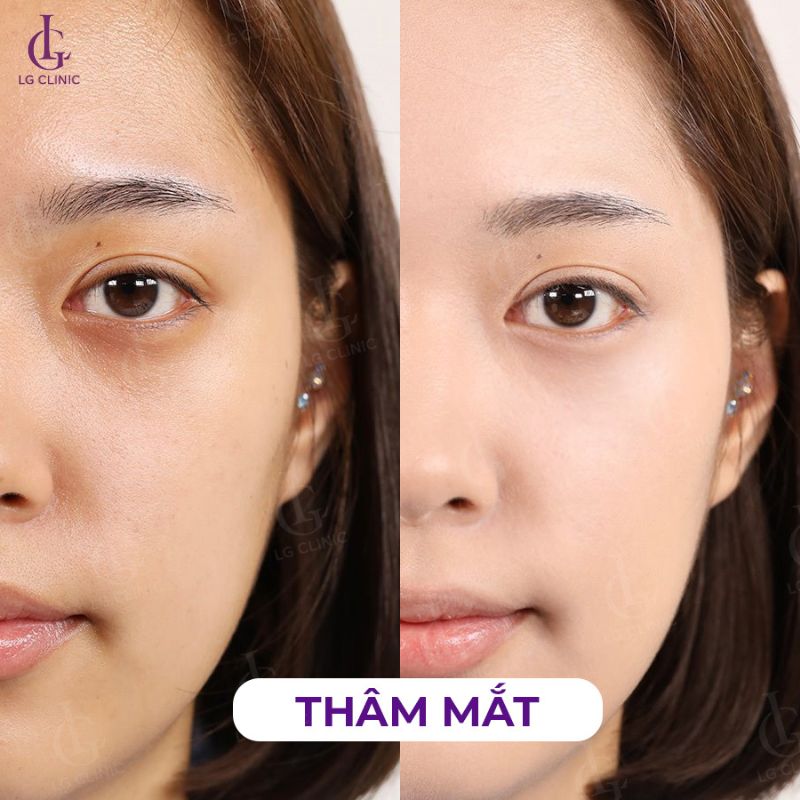hình khách hàng trị thâm mắt