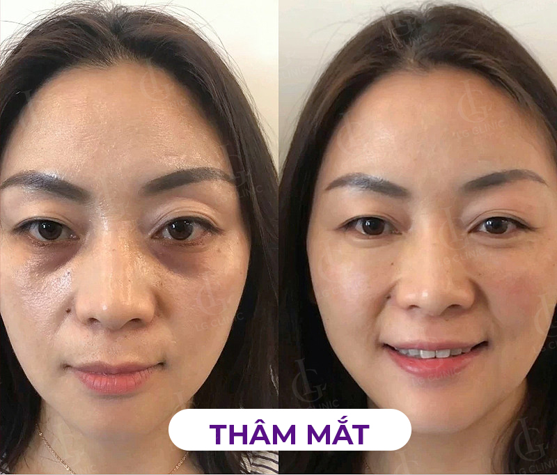 hình khách hàng trị thâm mắt