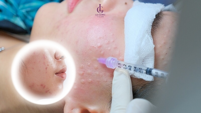 Tiêm meso kiềm dầu giúp cải thiện tình trạng da bóng nhờn