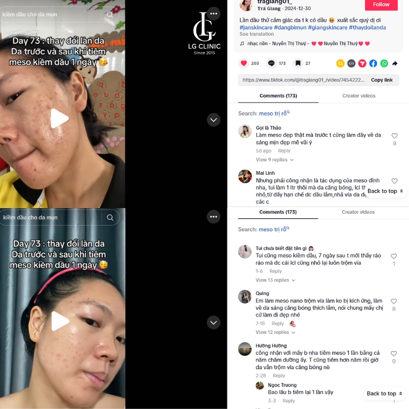 review tiêm meso kiềm dầu