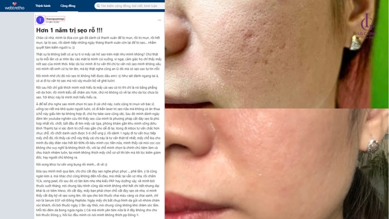 đánh giá tiêm meso trị sẹo 2