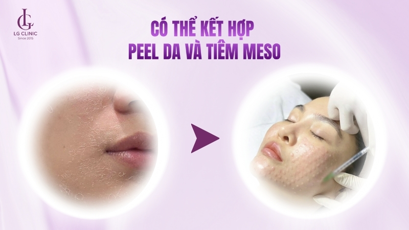 peel da xong có thể tiêm meso
