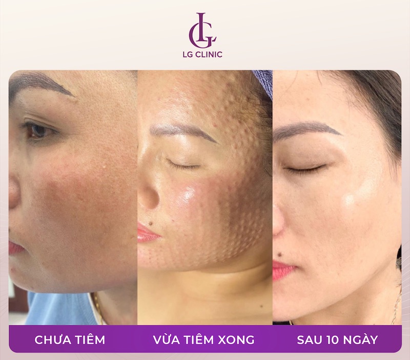 1 tuần sau tiêm meso da sẽ đẹp