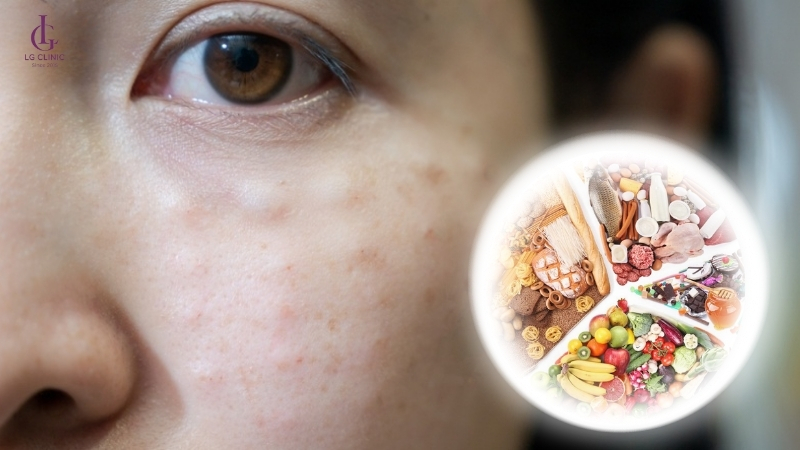 ảnh hưởng của chế độ ăn sau khi tiêm meso