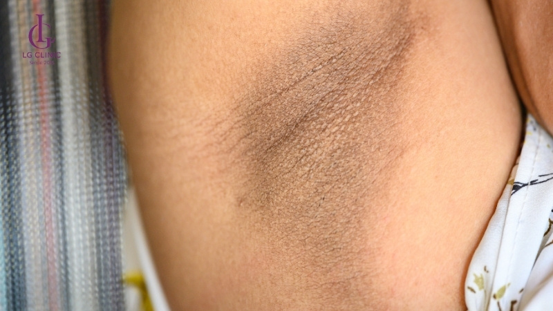 Tại sao nách bị thâm