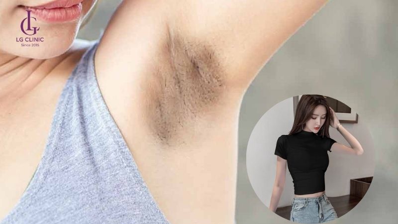 Tại sao nách bị thâm