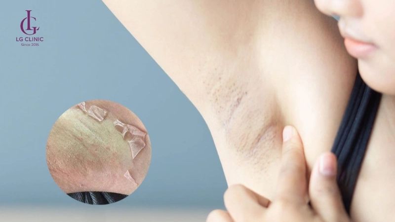 Tại sao nách bị thâm