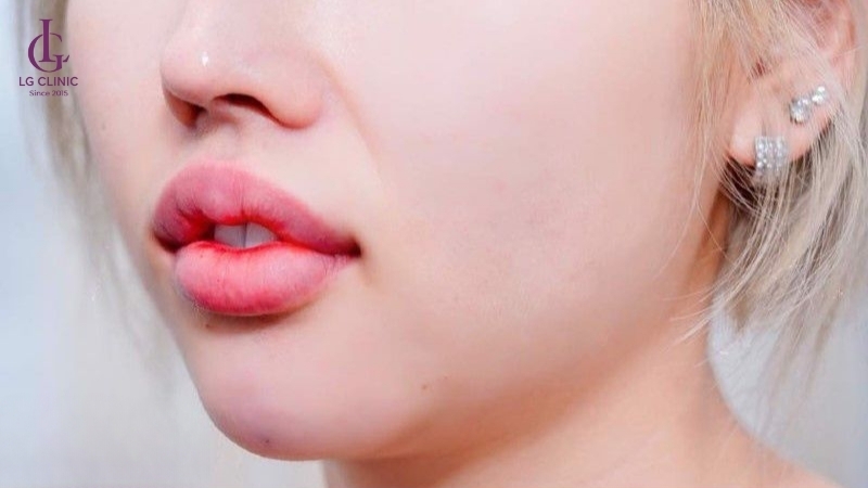 tiêm filler môi bị sưng