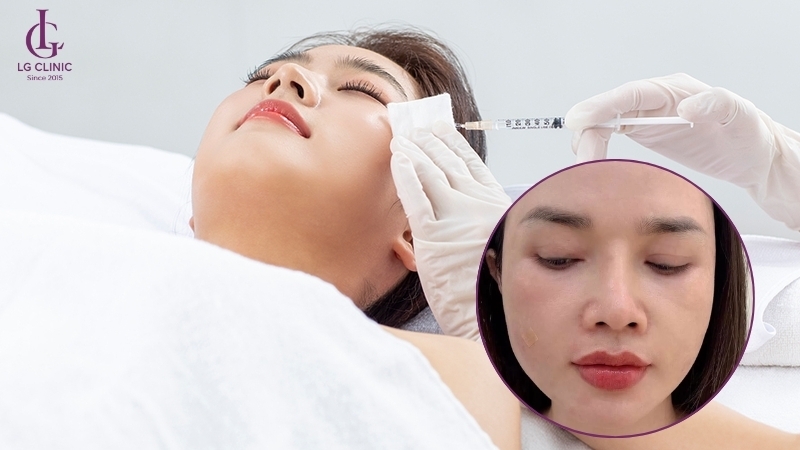 tiêm filler bị cứng