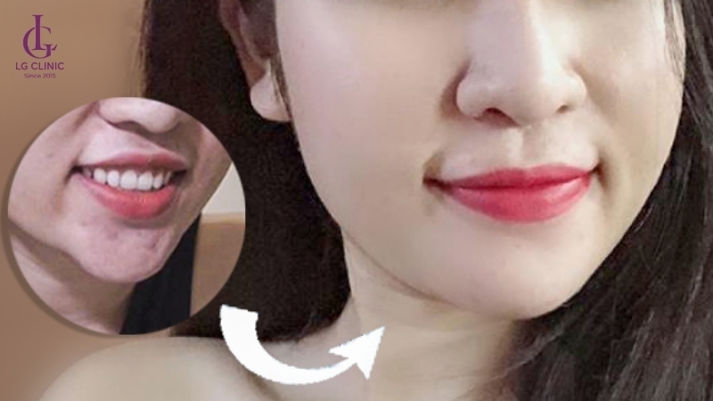 tiêm tan filler cằm