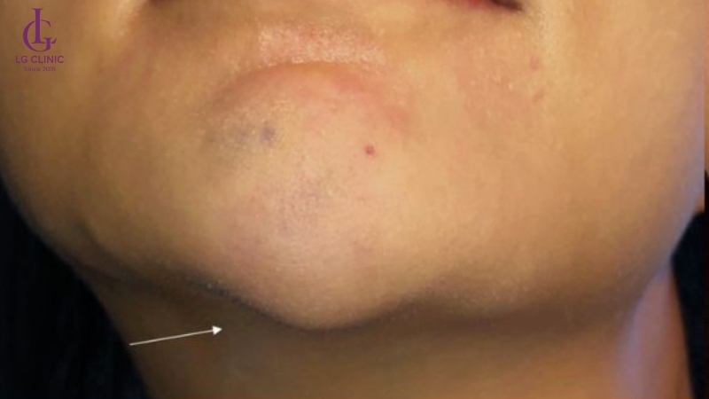 tiêm filler cằm bị u cục