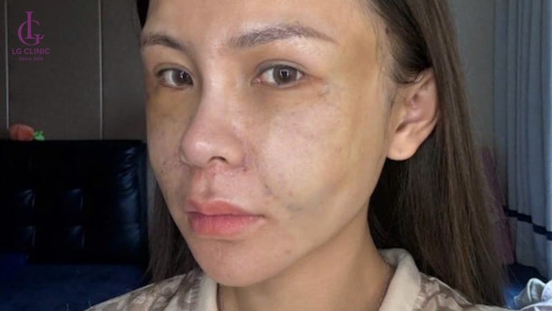 da bị chảy xệ sau khi tiêm filler