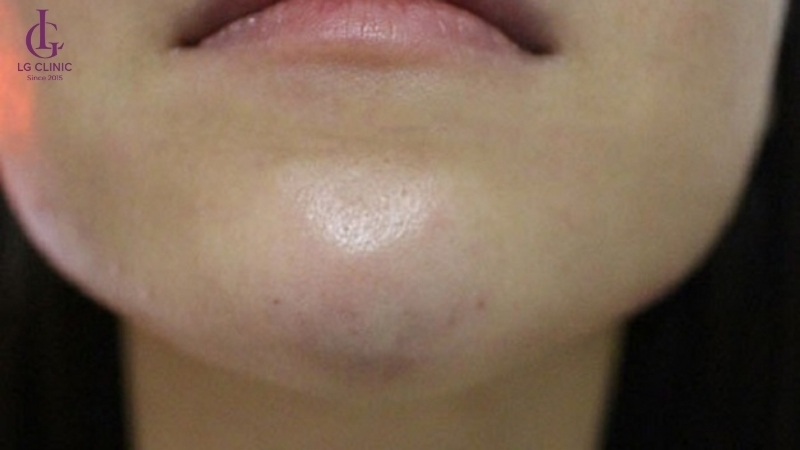 tiêm filler bị sưng