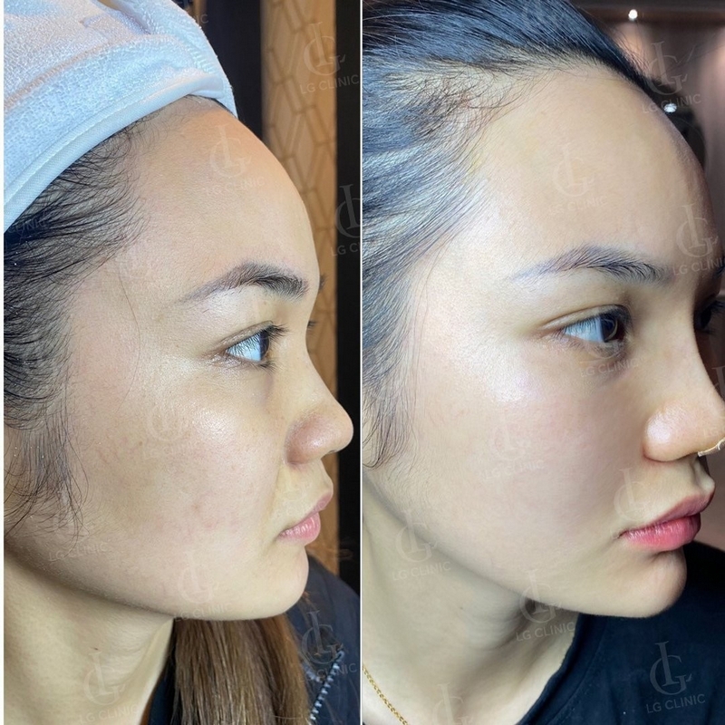 tiêm filler rãnh cười