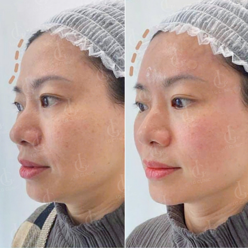 kết quả tiêm filler