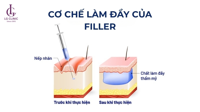 cơ chế tiêm filler