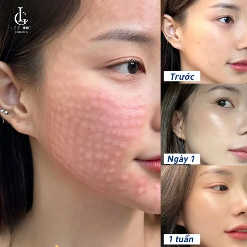 nốt tiêm meso bao lâu thì tan