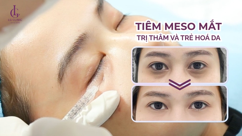 Tiêm meso trị thâm mắt