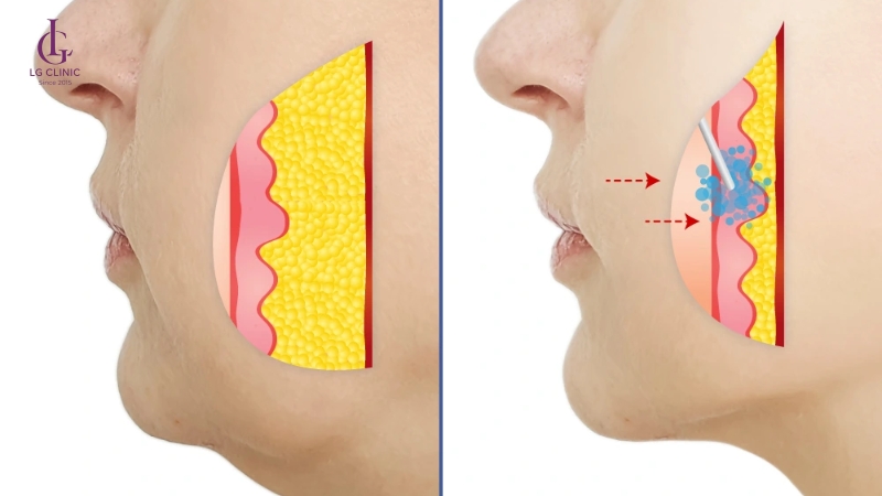 đốt cháy và phân huỷ mỡ