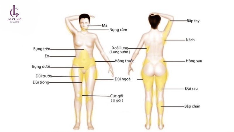 vị trí cần tiêm meso giảm mỡ