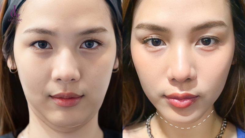 kết quả tiêm meso