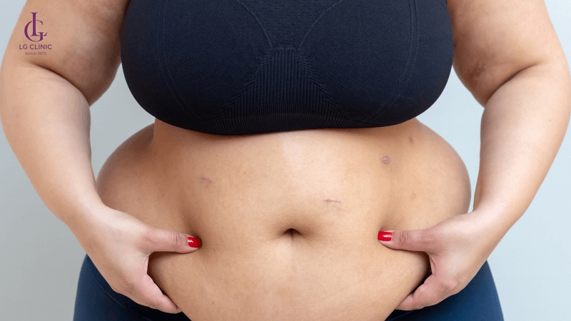 BMI trên 30 không nên thực hiện